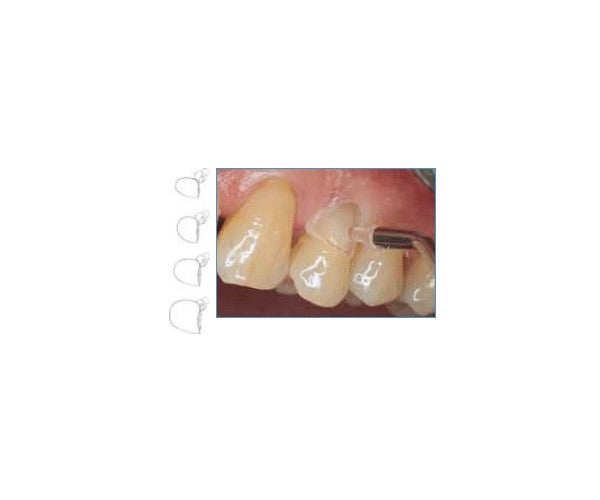 MATRICES CERVICALES LM p/incisales 60 ud