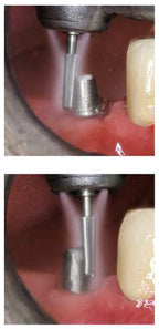 H847KRG.314.018  KOMET FRESA C. TUNGSTENO CONICA BORDE REDONDEADO TURBINA ø 018  5 ud.