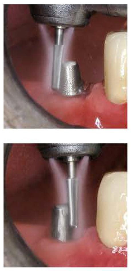 H847KRG.314.018  KOMET FRESA C. TUNGSTENO CONICA BORDE REDONDEADO TURBINA ø 018  5 ud.