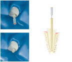 DENTINPOST KOMET ER DPC1L12.000.070 10 ud
