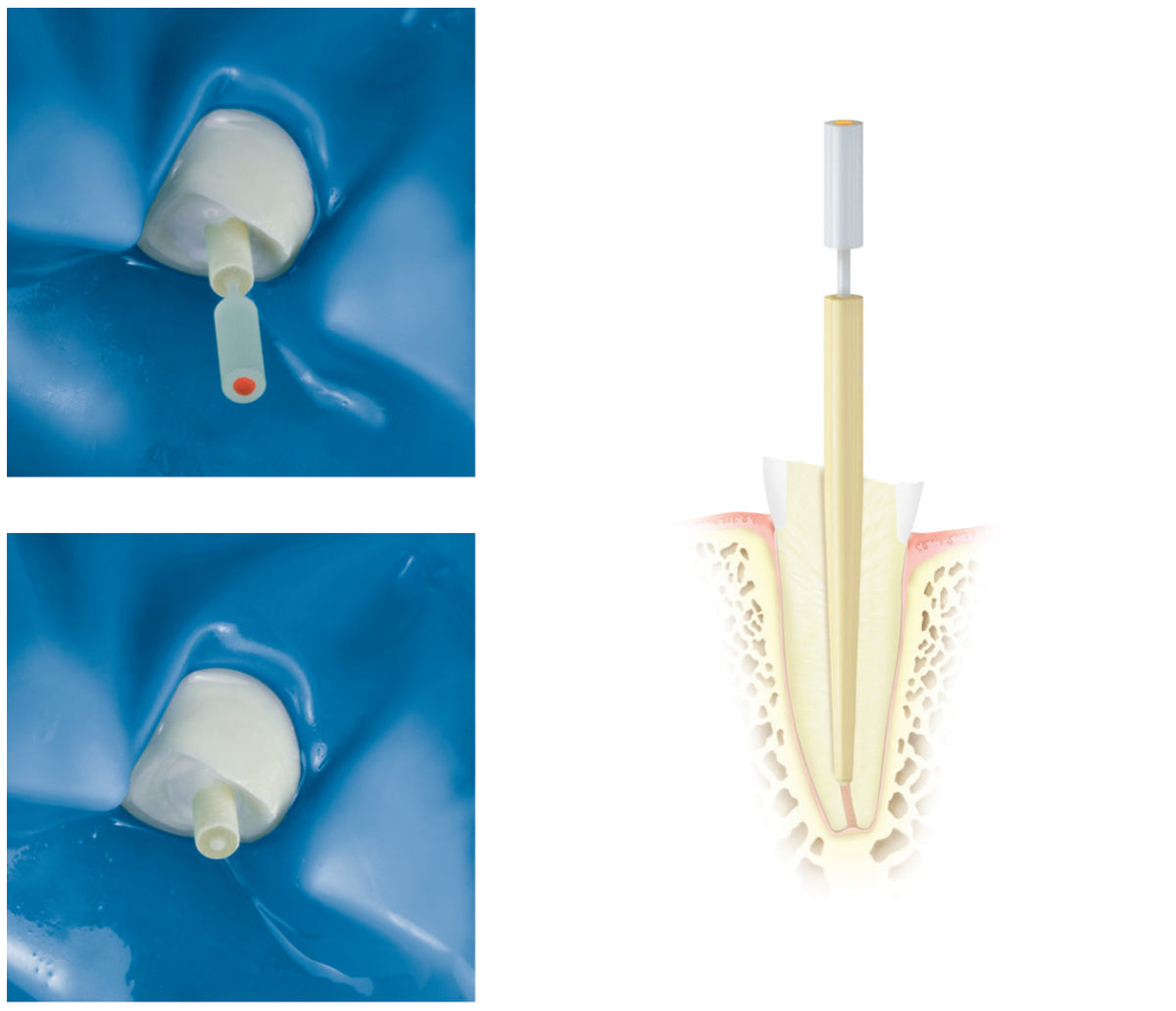 DENTINPOST KOMET ER DPC1L12.000.070 10 ud