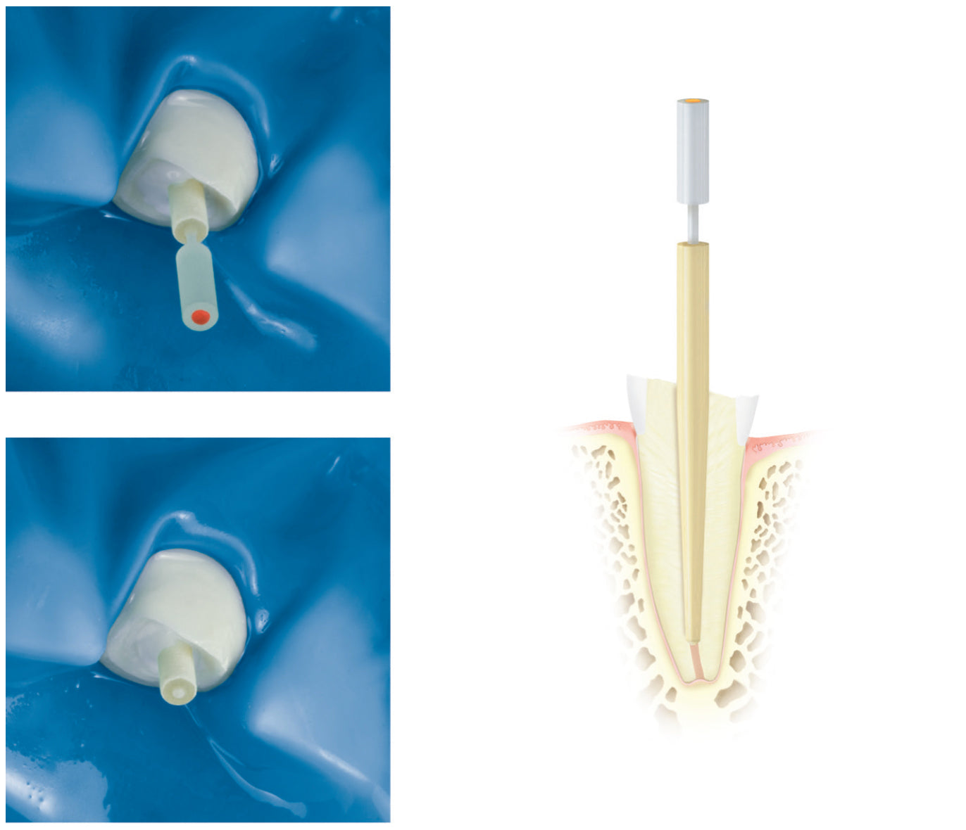 DENTINPOST KOMET ER DPC1L12.000.090 10 ud