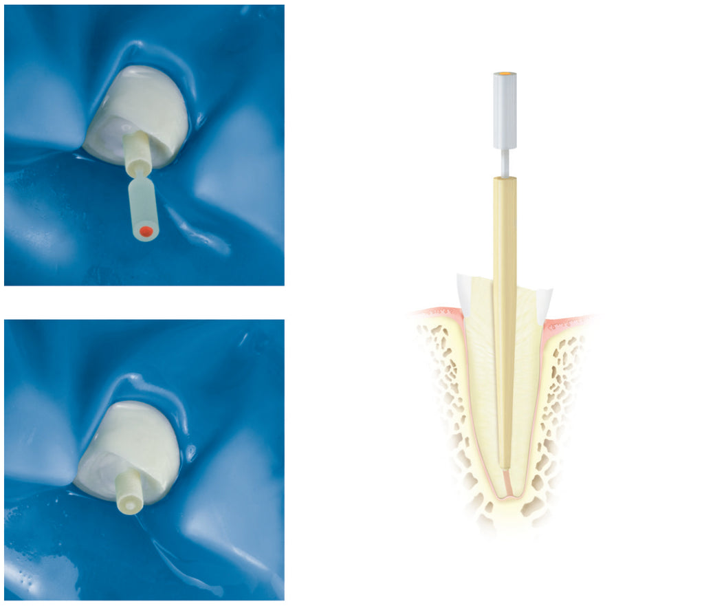 DENTINPOST KOMET ER DPC1L12.000.110 10 ud