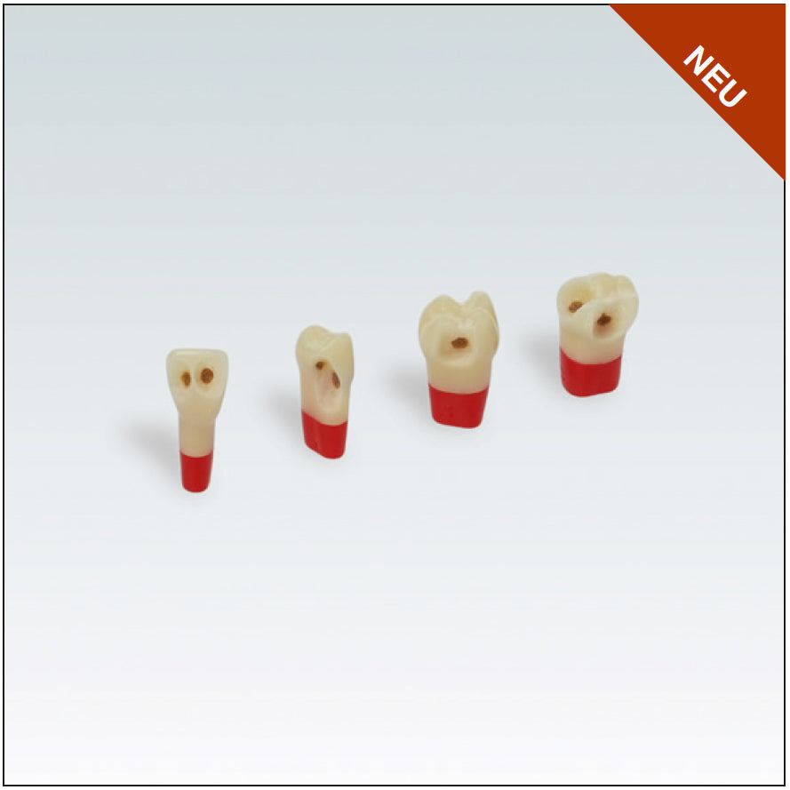 AG3ZSDPK.300V1 21 diente c/esmalte, dentina y pulpa c/caries