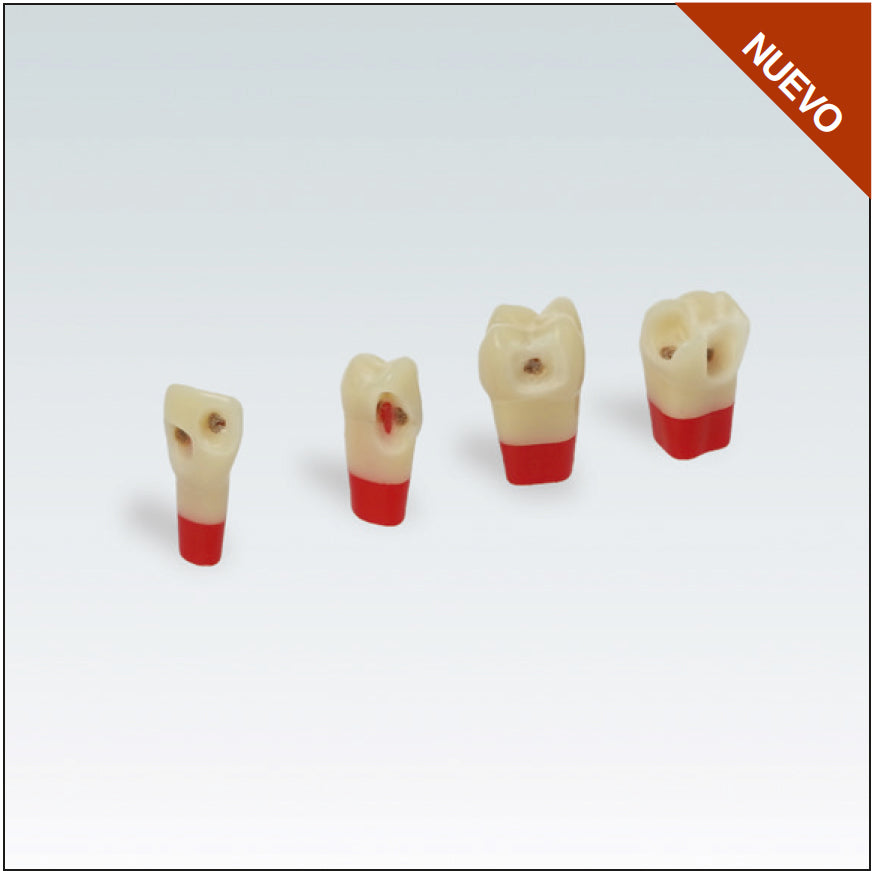 ANA4ZSDPK Nº46 diente esmalte-dentina-pulpa c/caries
