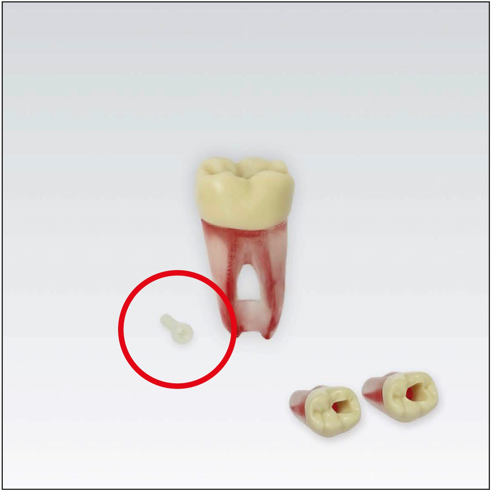 0326 FRASACO cargol plàstic p/dents d'endo