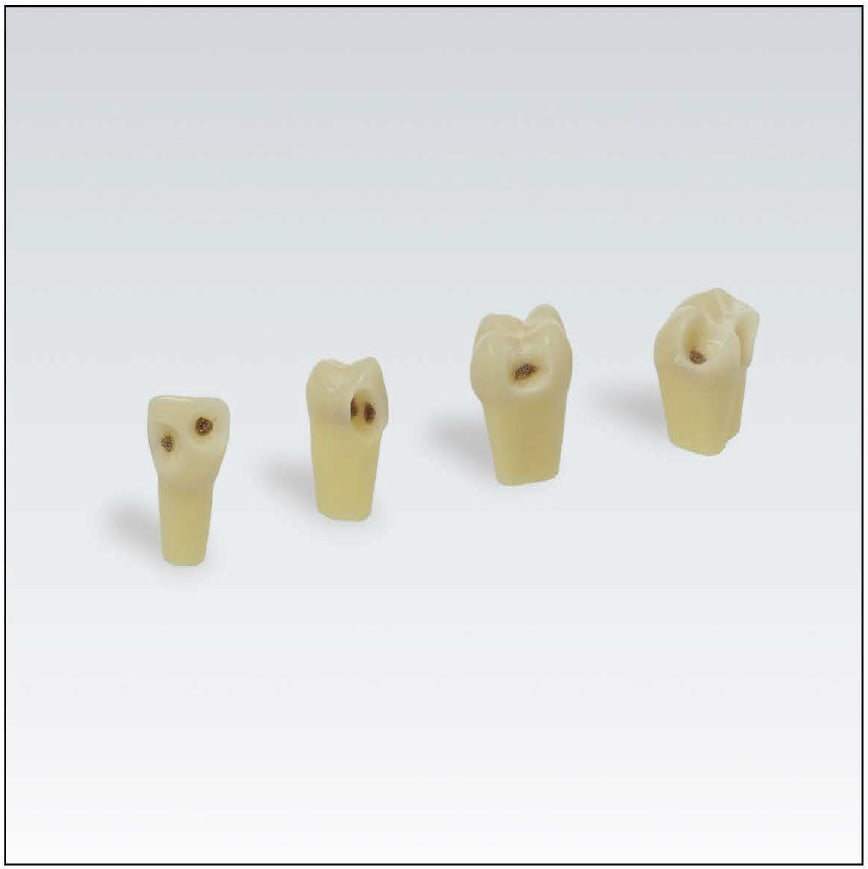 ANA4ZSDK.301V1 Nº46 enamel-dentin tooth with cavities