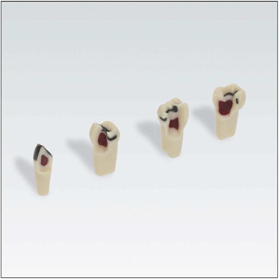 AK62ZPUWPK Nº55 pulpa rellena c/cera y caries 1 ud