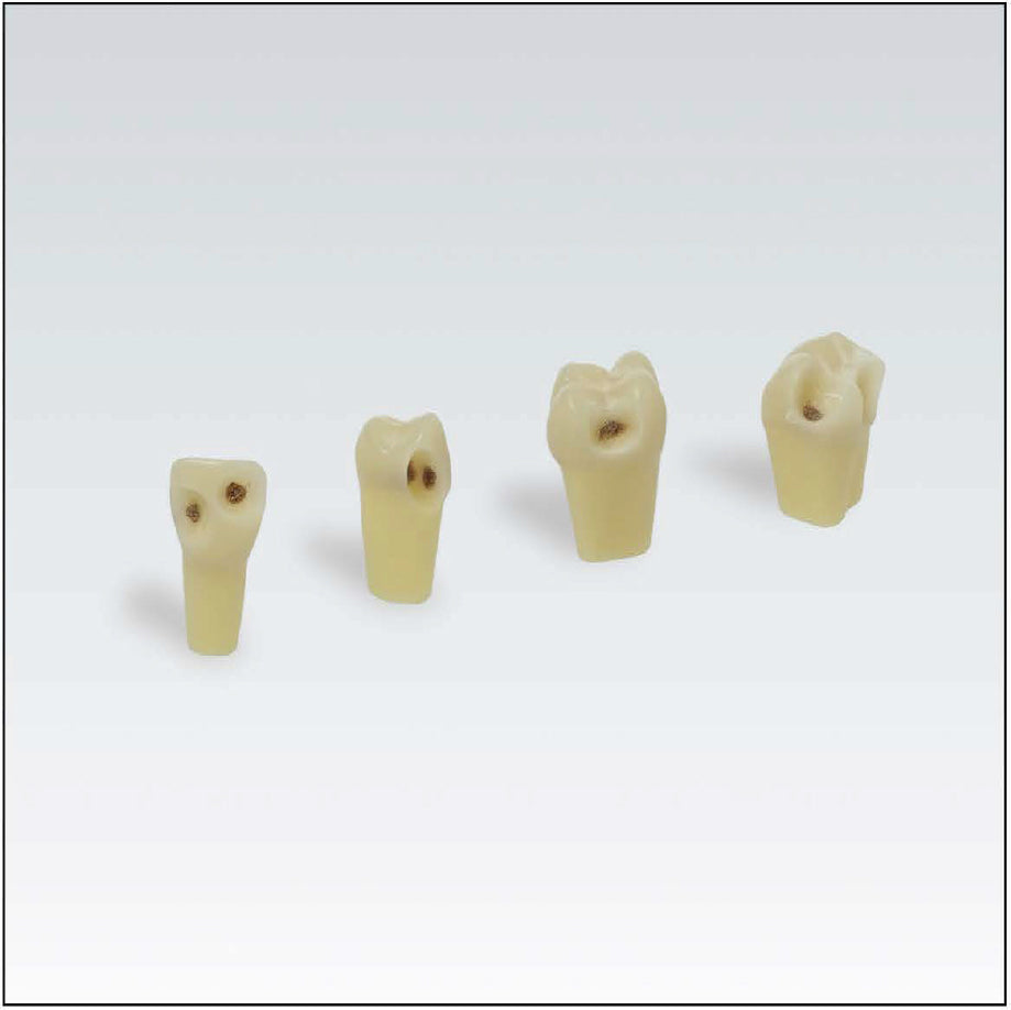 ANA4ZSDK301V1 Nº27 diente esmalte-dentina c/caries