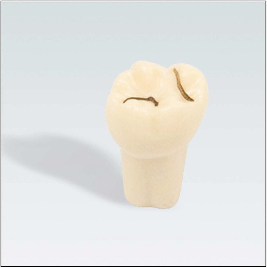 AK62ZFK nº16 diente con caries de fisura maxilar